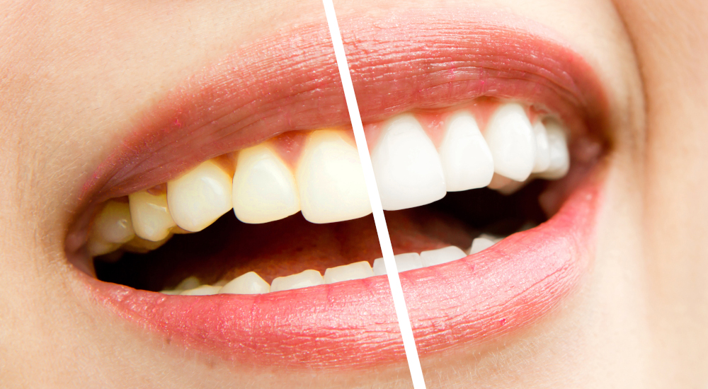 voor en na tanden bleken before and after whitening prima e dopo sbiancamento dentale